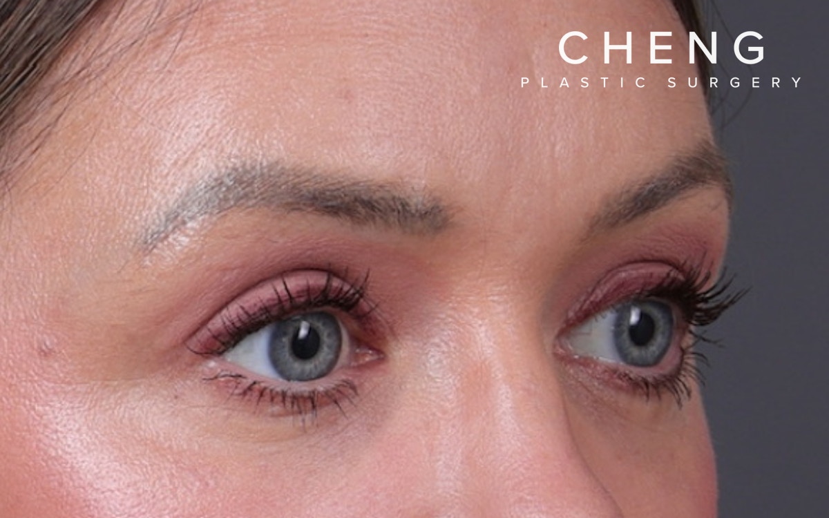 Blepharoplasty Before & After Gallery - Patient 390022 - Image 4