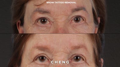 Brow Tattoo Removal Before & After Gallery - Patient 139243 - Image 1