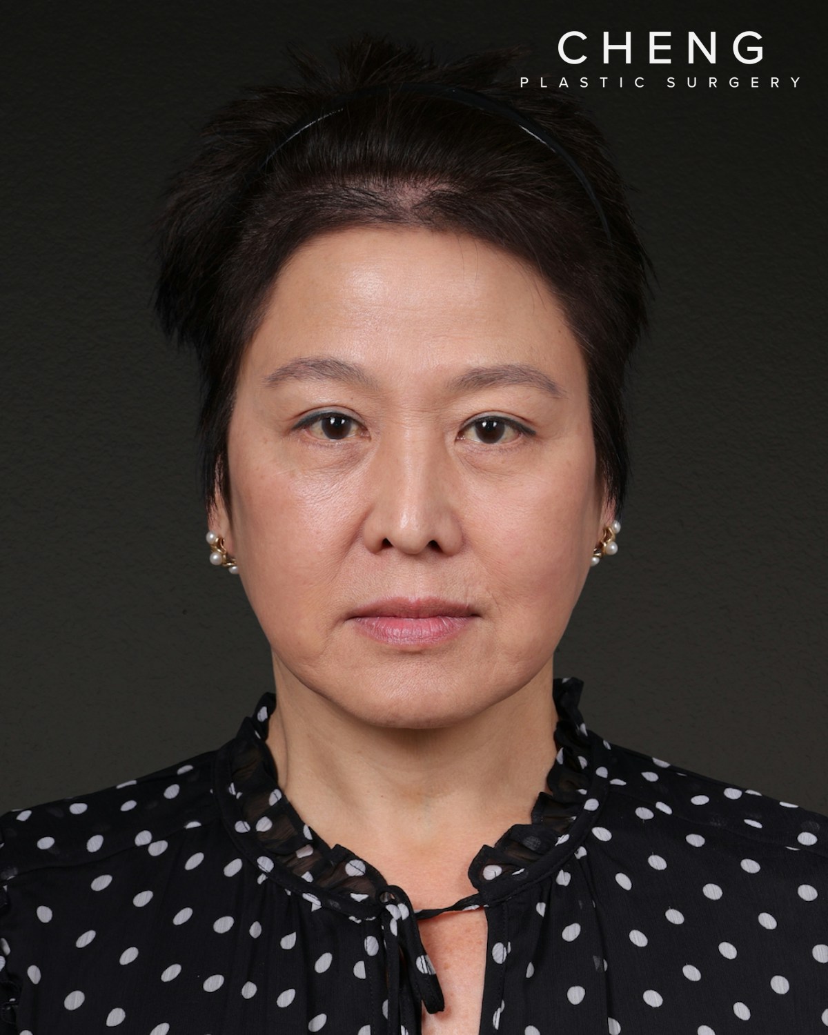 Facelift Before & After Gallery - Patient 285357 - Image 2
