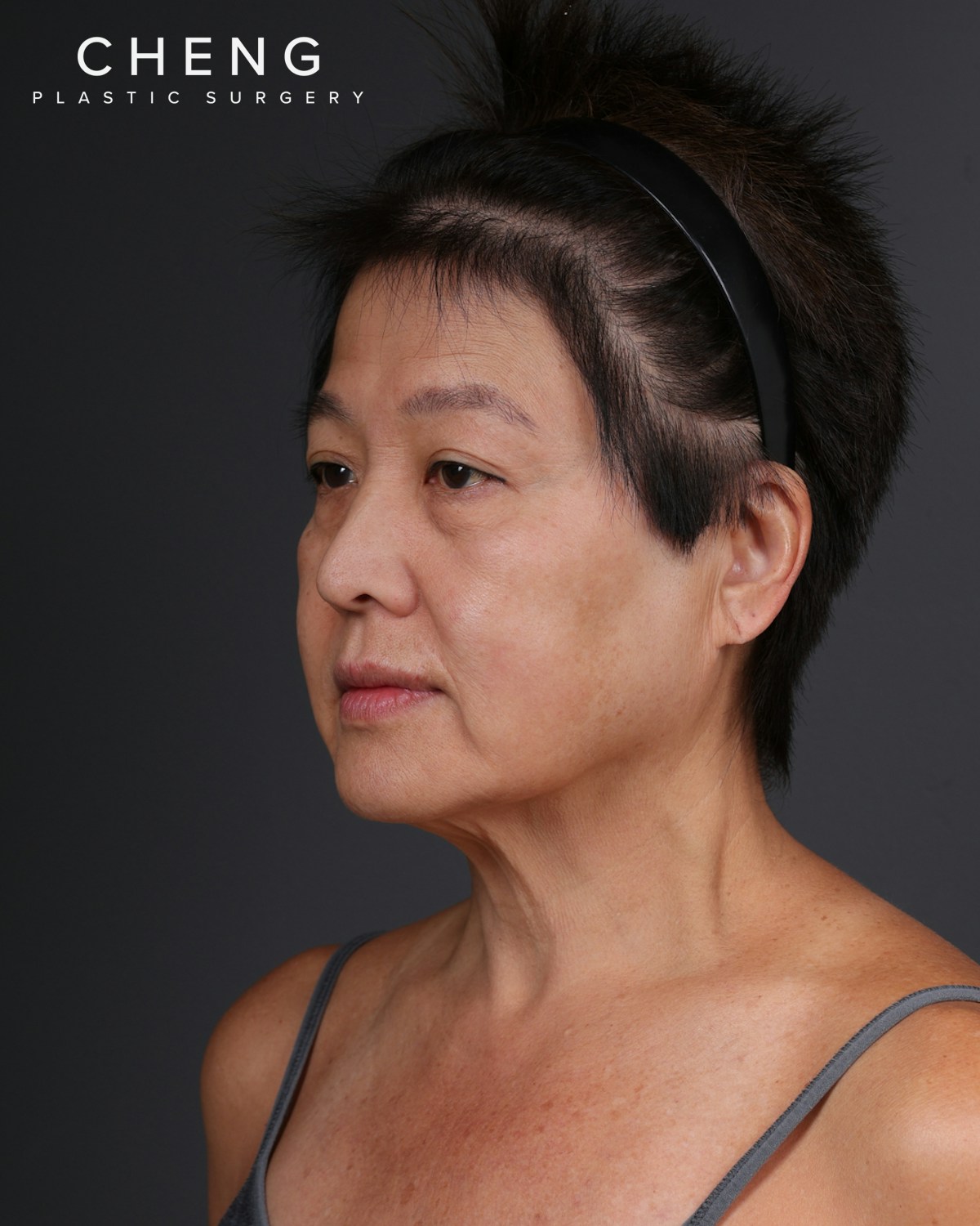 Facelift Before & After Gallery - Patient 285357 - Image 7