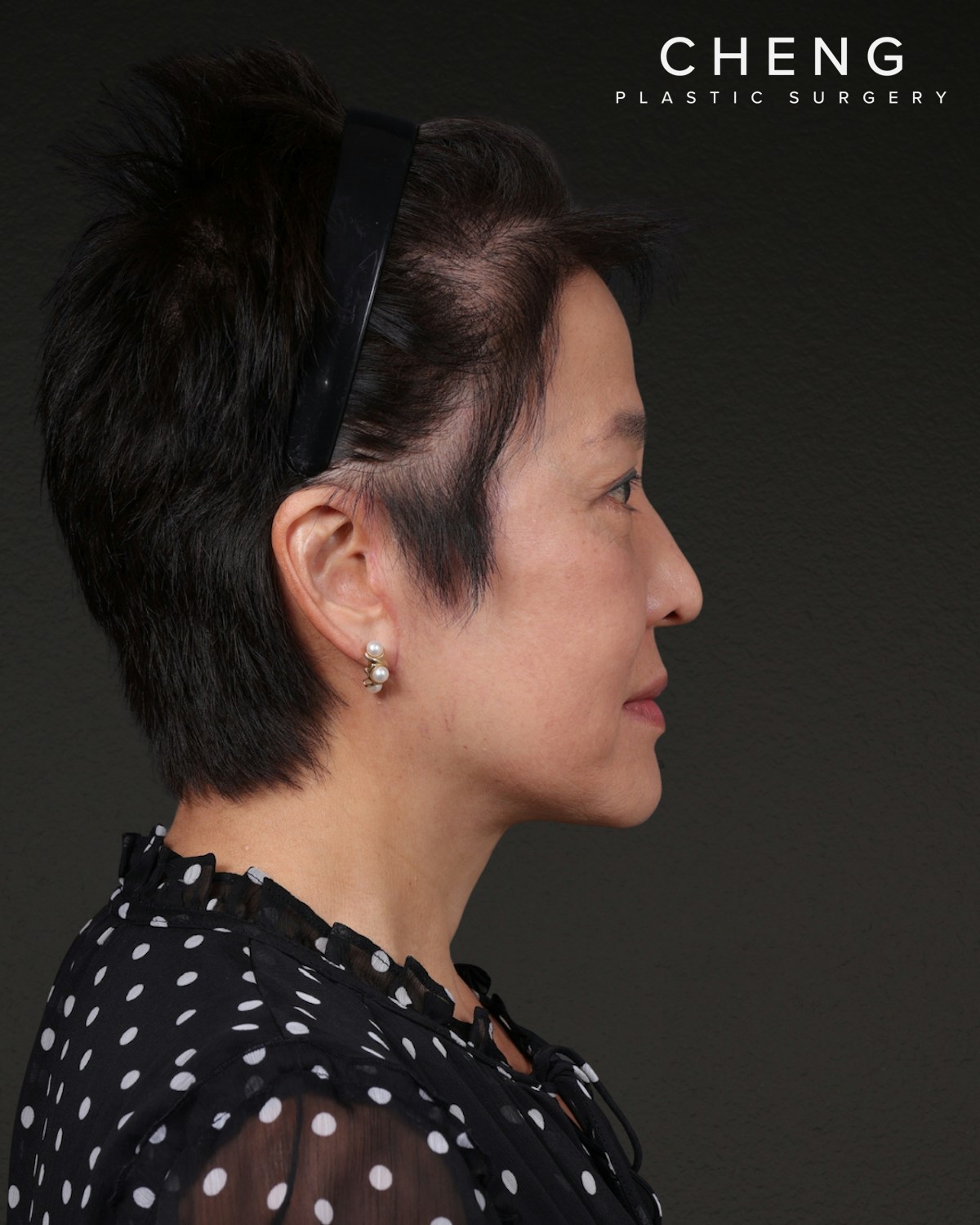 Facelift Before & After Gallery - Patient 285357 - Image 6