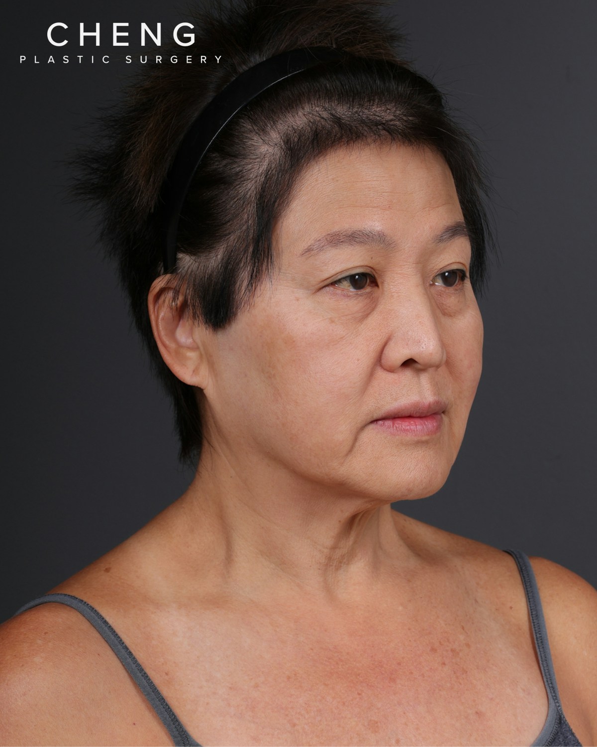 Facelift Before & After Gallery - Patient 285357 - Image 3