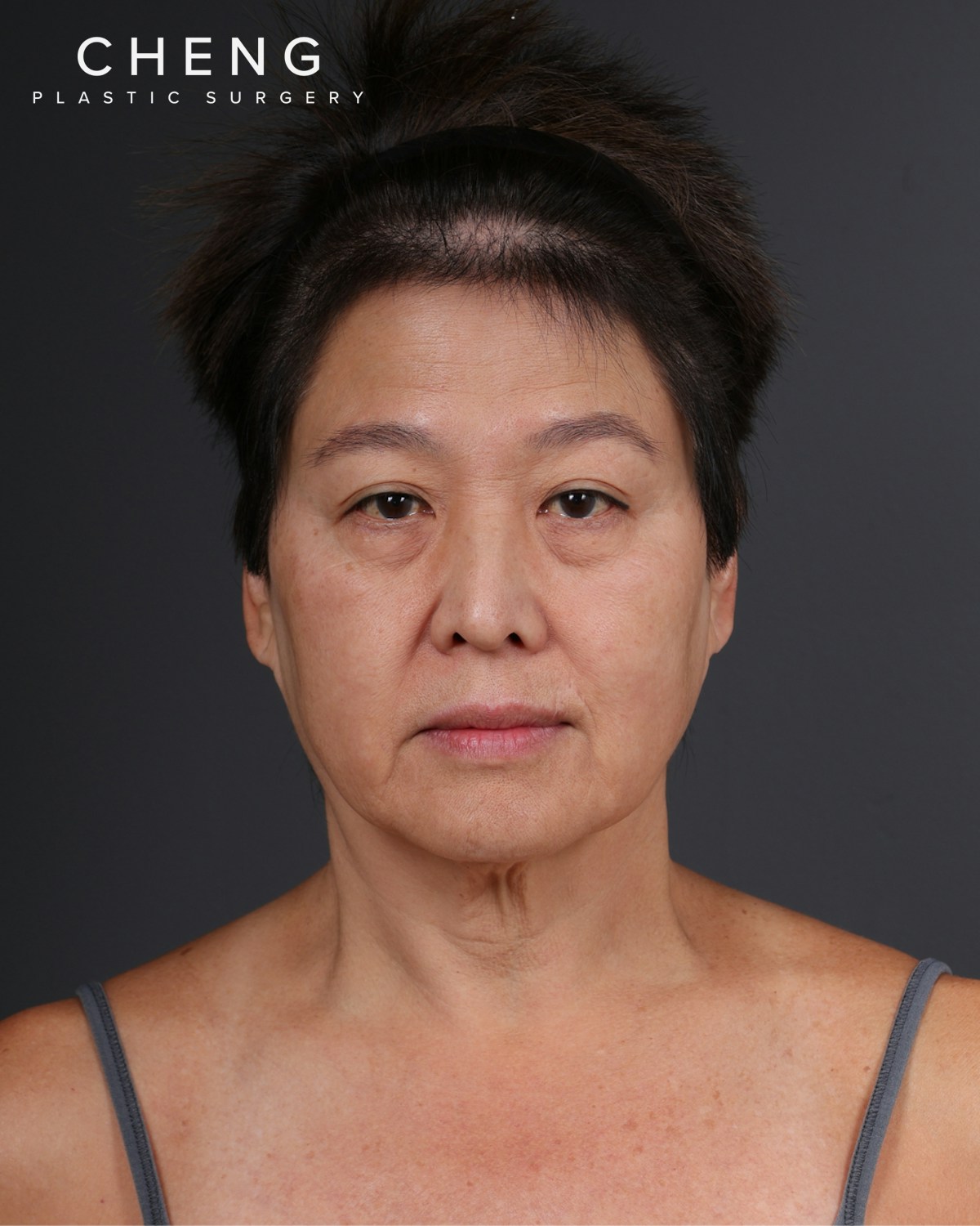 Facelift Before & After Gallery - Patient 285357 - Image 1