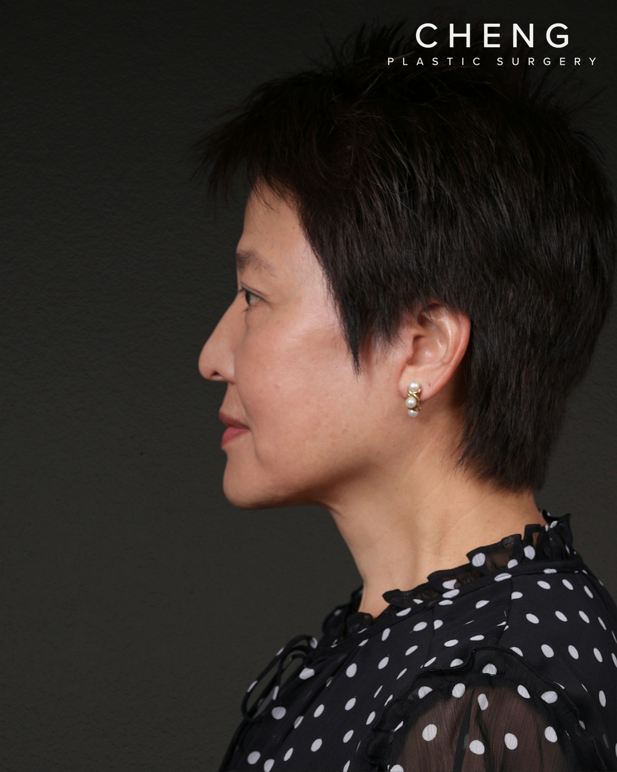 Facelift Before & After Gallery - Patient 285357 - Image 10