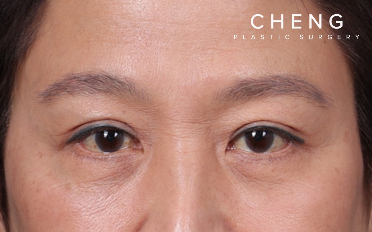 Blepharoplasty Before & After Gallery - Patient 114244 - Image 2