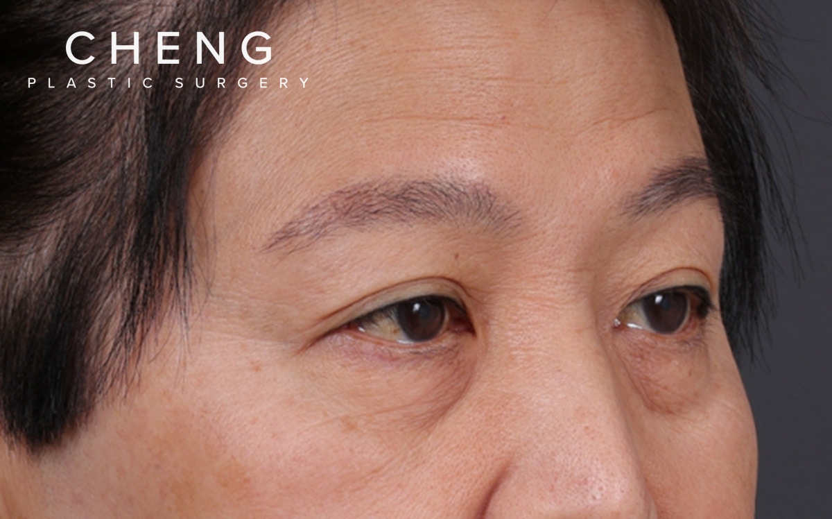 Blepharoplasty Before & After Gallery - Patient 114244 - Image 3