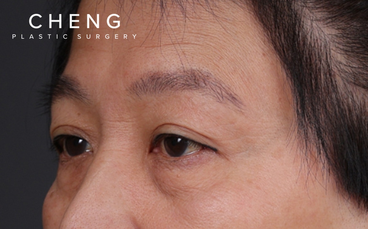 Blepharoplasty Before & After Gallery - Patient 114244 - Image 7