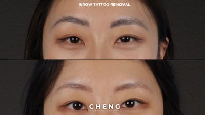 Brow Tattoo Removal Before & After Gallery - Patient 889037 - Image 1