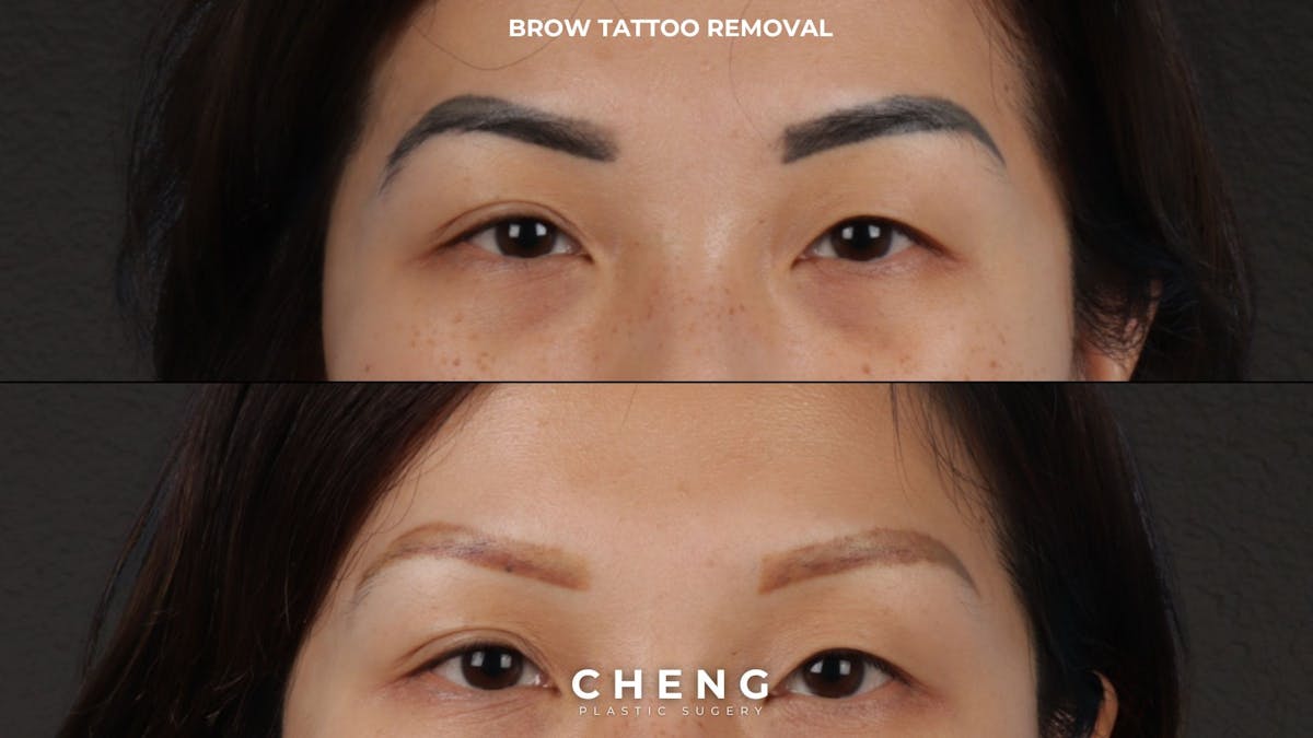Brow Tattoo Removal Before & After Gallery - Patient 412607 - Image 1