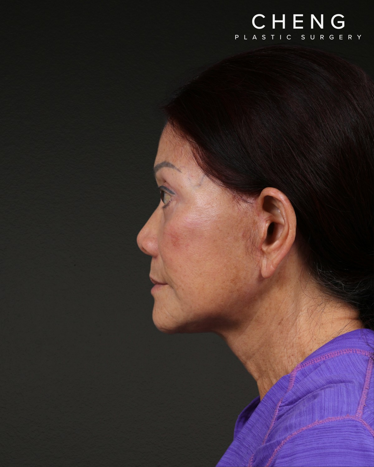 Facelift Before & After Gallery - Patient 166951 - Image 2