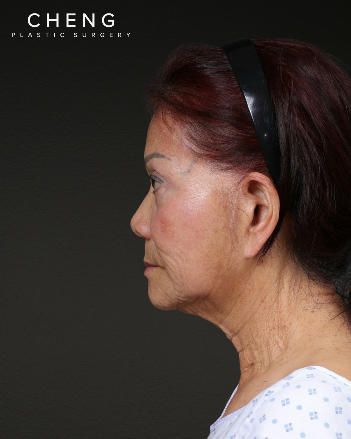 Facelift Before & After Gallery - Patient 166951 - Image 1