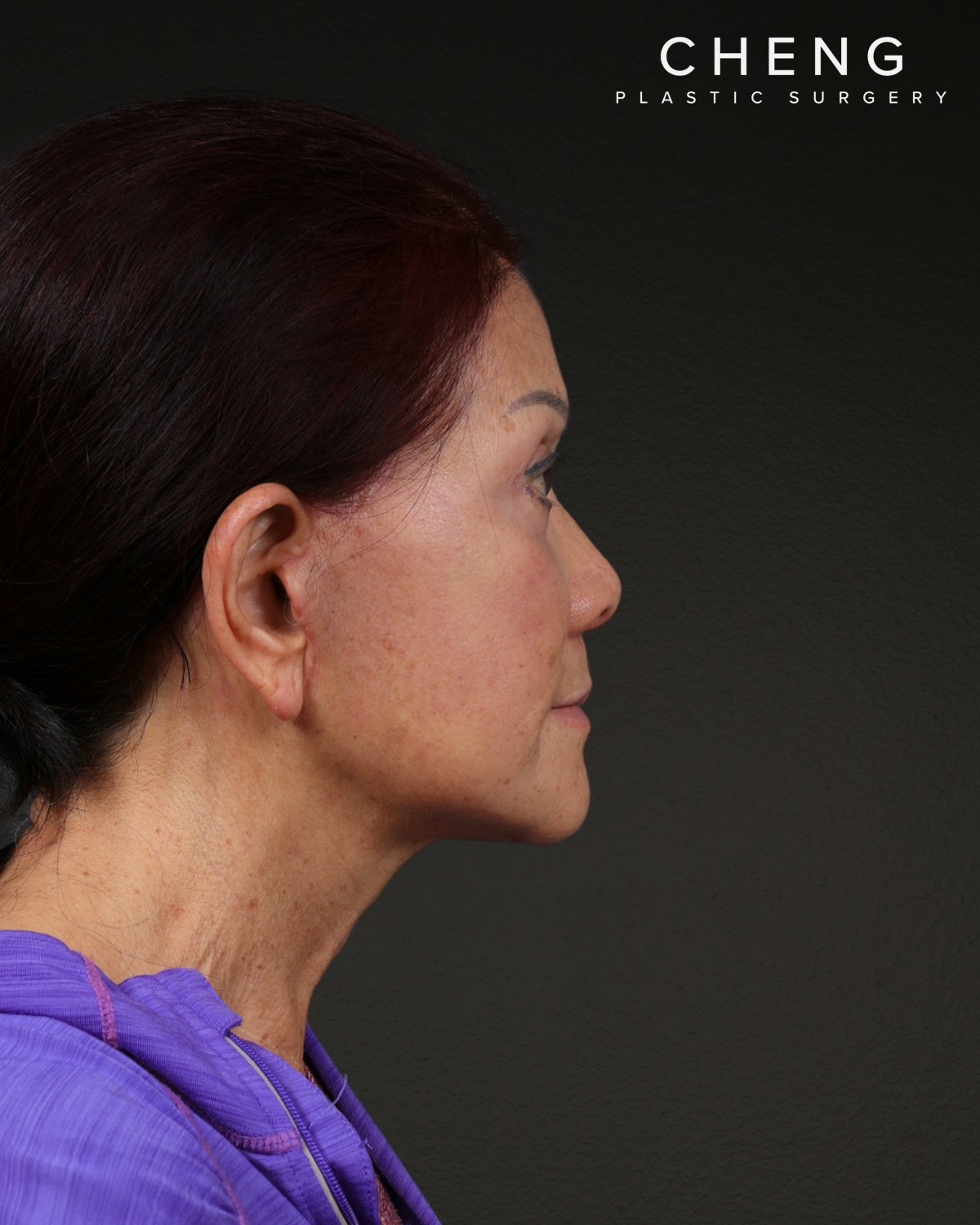 Facelift Before & After Gallery - Patient 166951 - Image 4