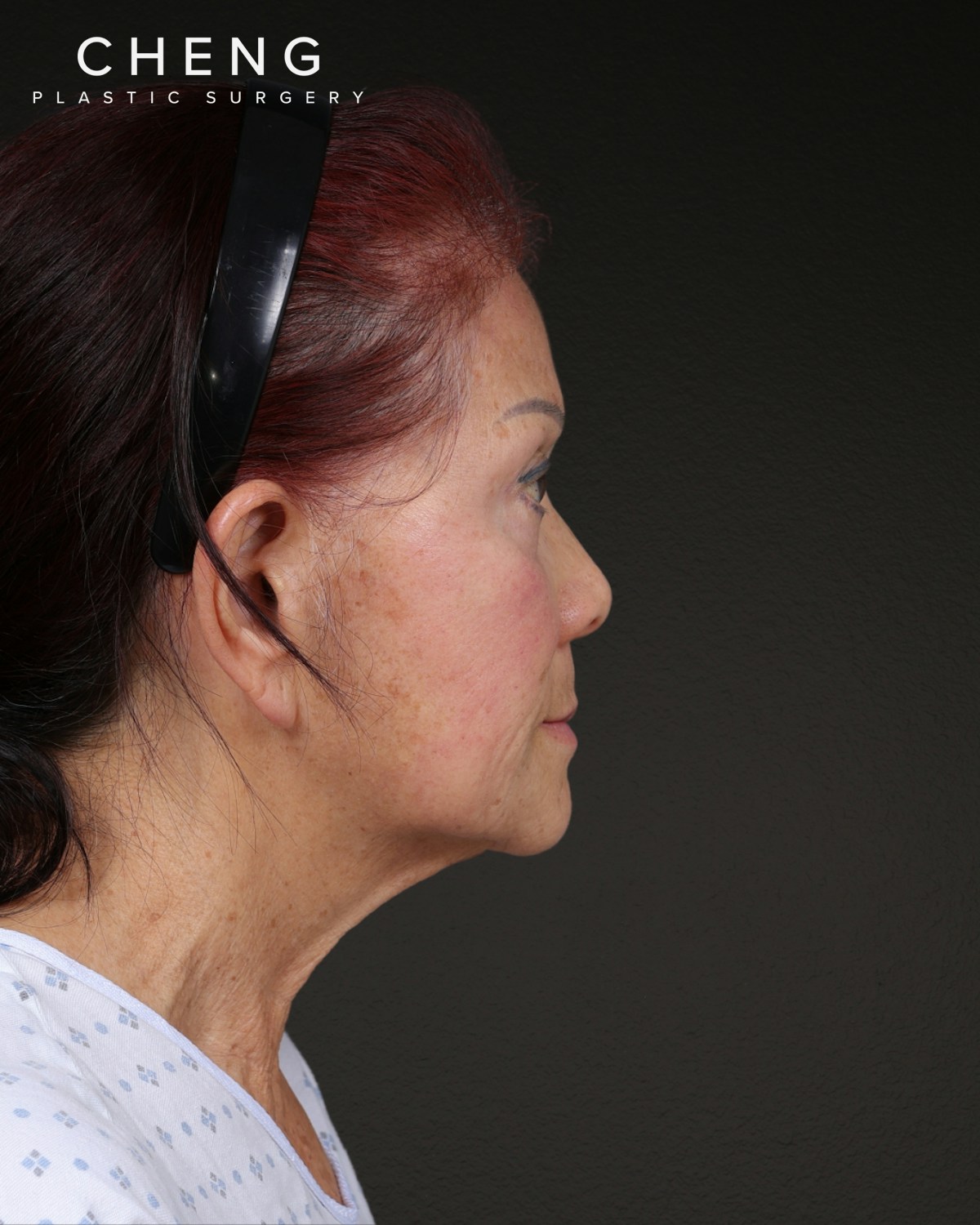 Facelift Before & After Gallery - Patient 166951 - Image 3