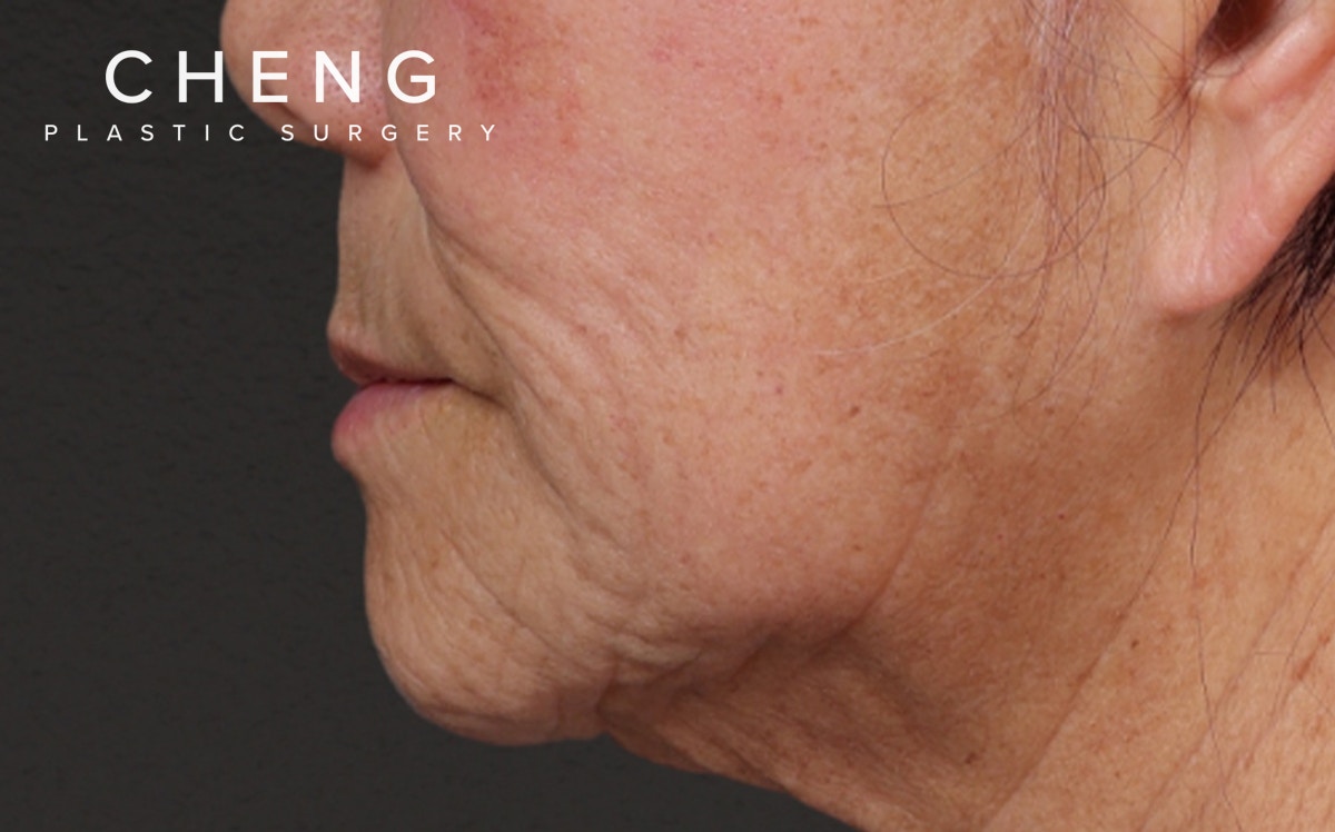 Lip Lift Before & After Gallery - Patient 250390 - Image 3