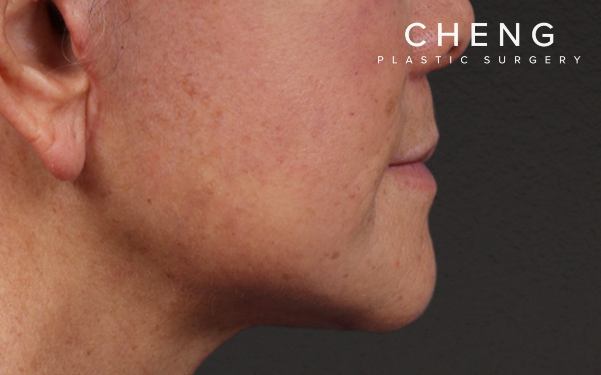 Lip Lift Before & After Gallery - Patient 250390 - Image 2