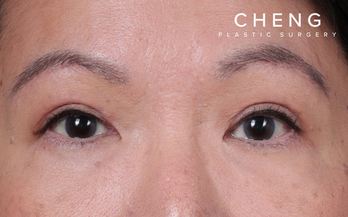 Brow Lift Before & After Gallery - Patient 400205 - Image 2