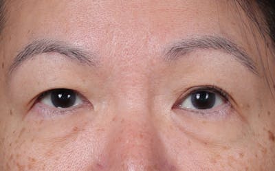 Blepharoplasty Before & After Gallery - Patient 107253 - Image 1
