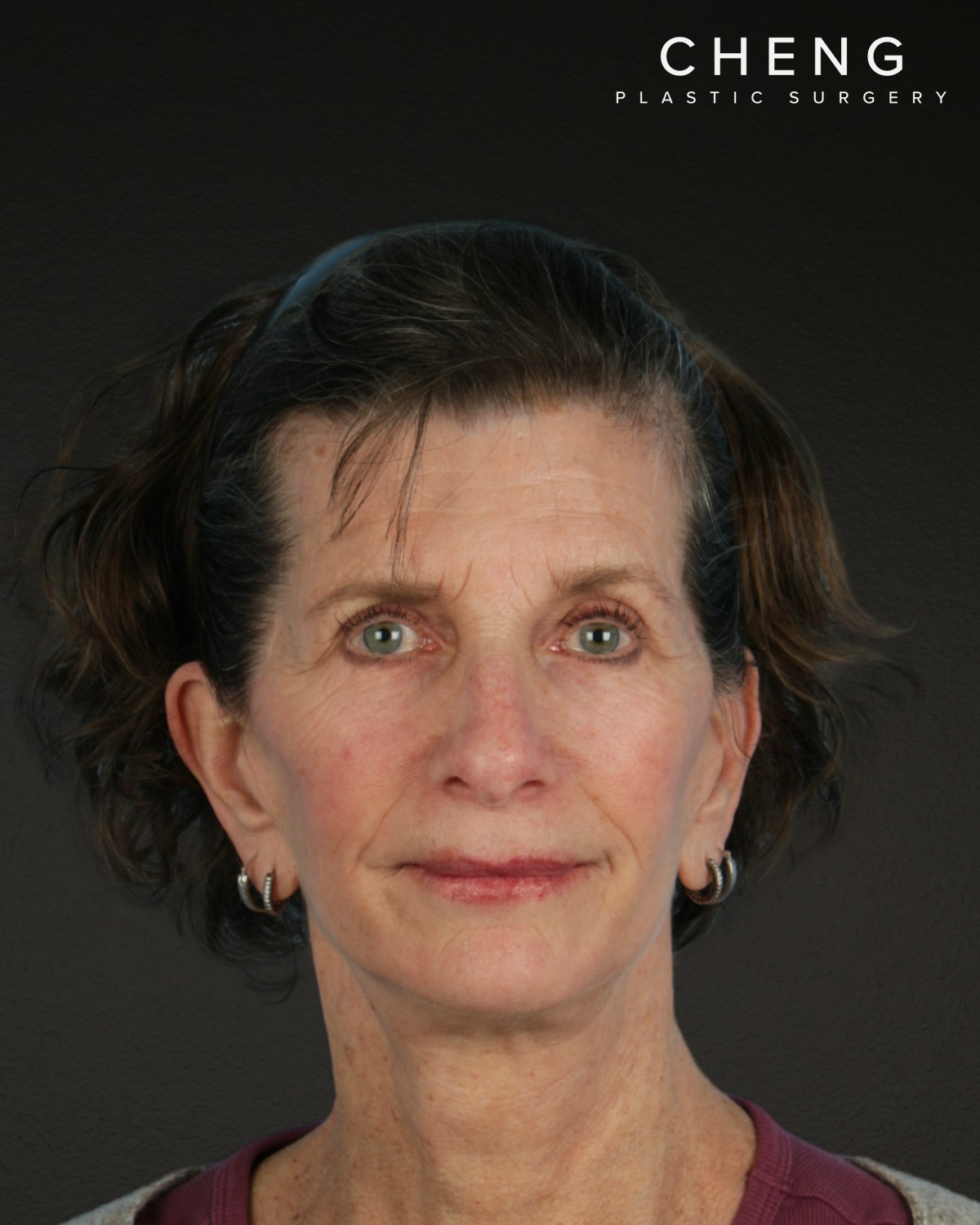 Facelift Before & After Gallery - Patient 307064 - Image 2
