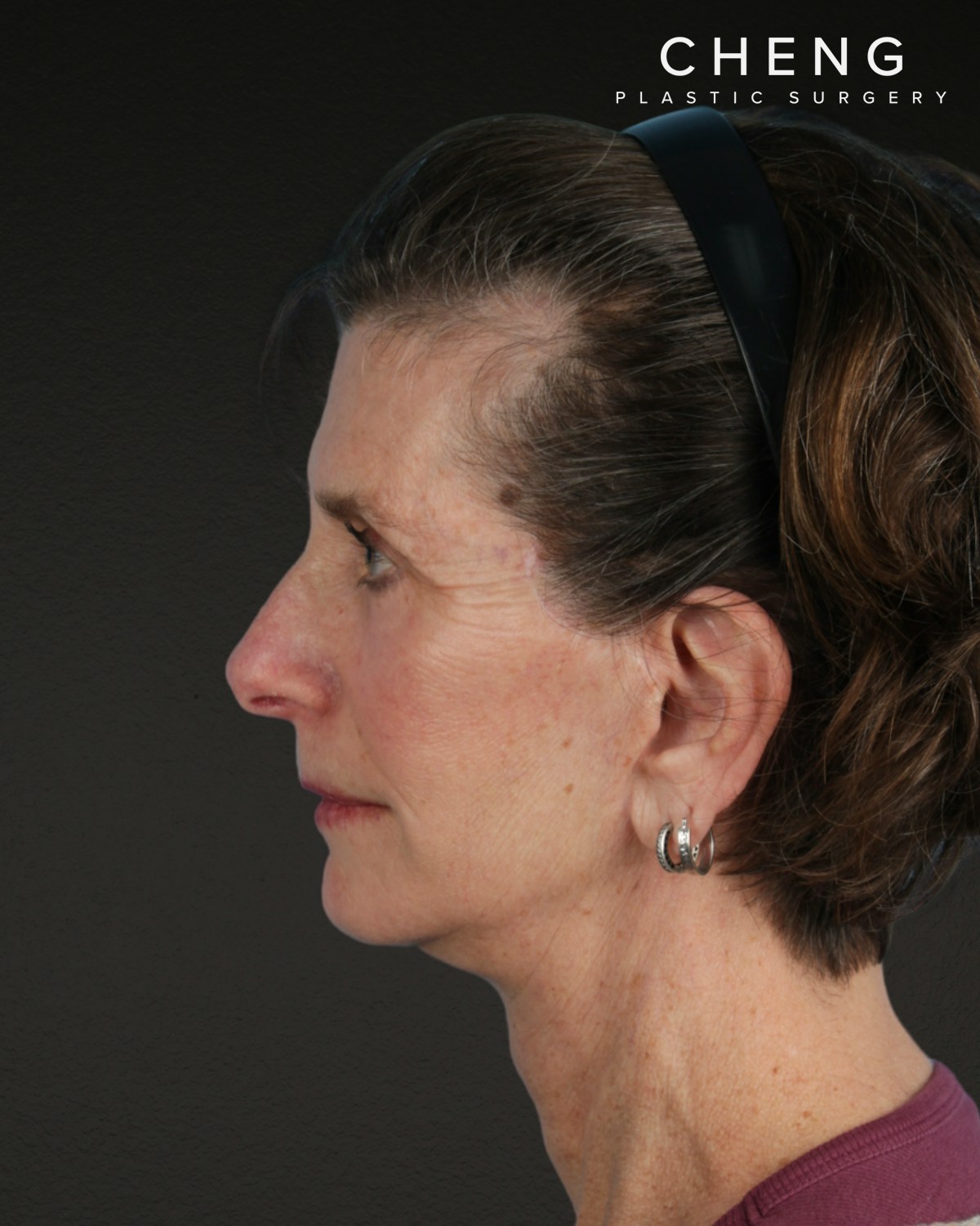 Facelift Before & After Gallery - Patient 307064 - Image 10