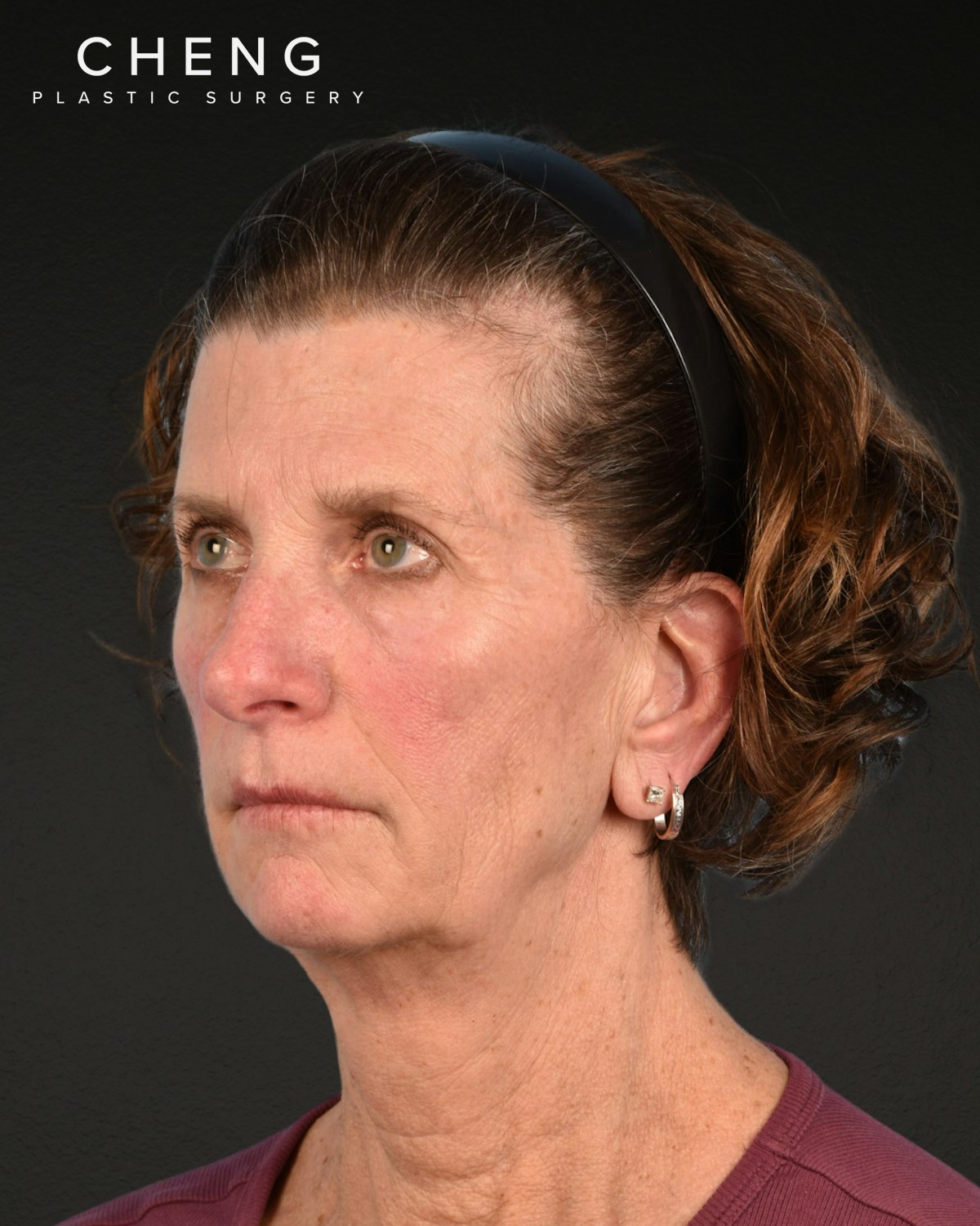 Facelift Before & After Gallery - Patient 307064 - Image 7