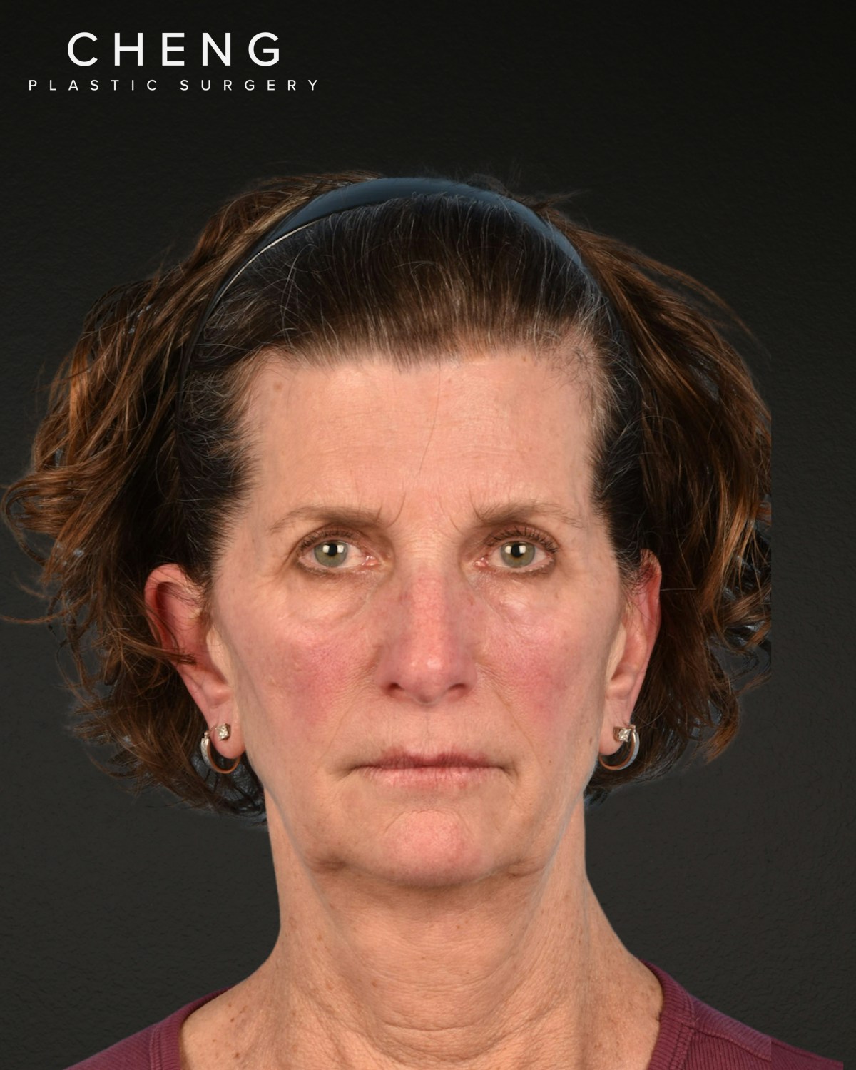 Facelift Before & After Gallery - Patient 307064 - Image 1