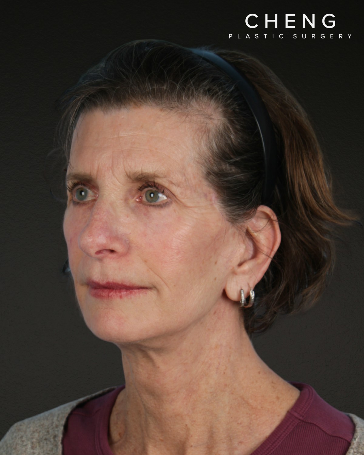 Facelift Before & After Gallery - Patient 307064 - Image 8