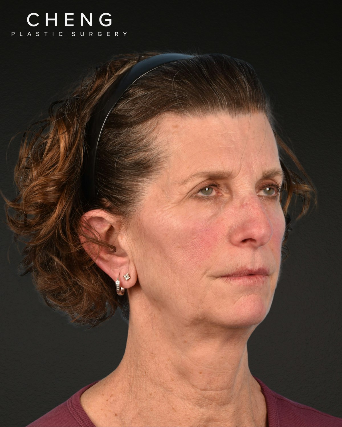 Facelift Before & After Gallery - Patient 307064 - Image 3