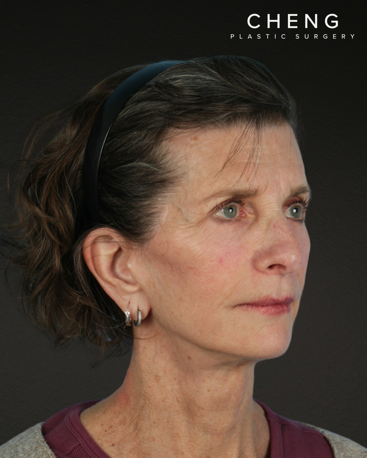 Facelift Before & After Gallery - Patient 307064 - Image 4