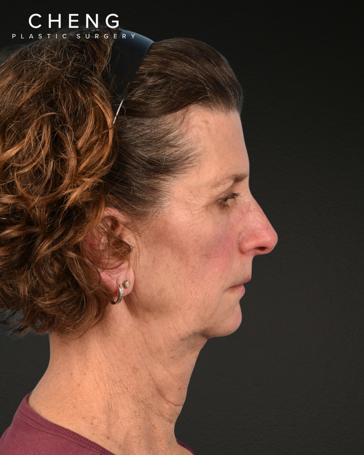 Facelift Before & After Gallery - Patient 307064 - Image 5