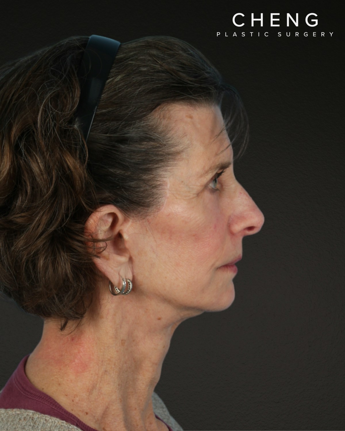 Facelift Before & After Gallery - Patient 307064 - Image 6