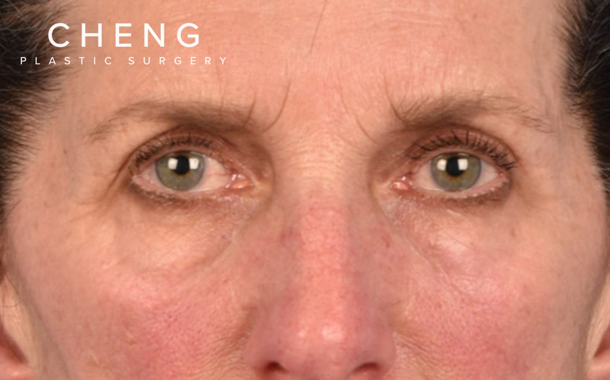 Blepharoplasty Before & After Gallery - Patient 364311 - Image 1