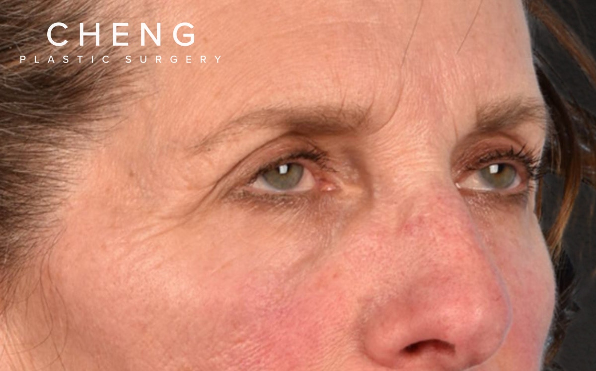 Blepharoplasty Before & After Gallery - Patient 364311 - Image 3