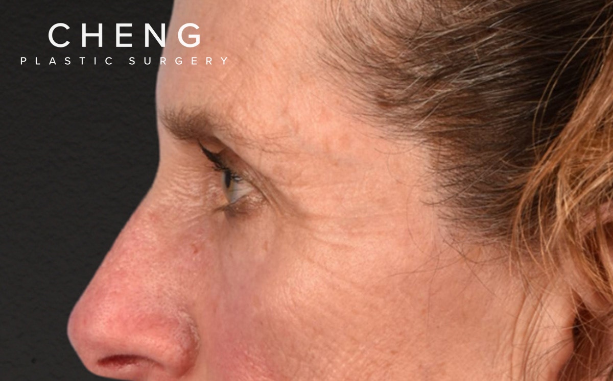 Blepharoplasty Before & After Gallery - Patient 364311 - Image 9
