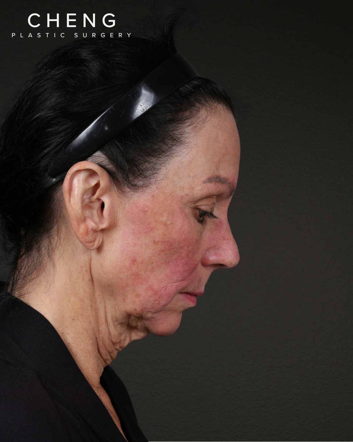 Neck Lift Before & After Gallery - Patient 255571 - Image 5