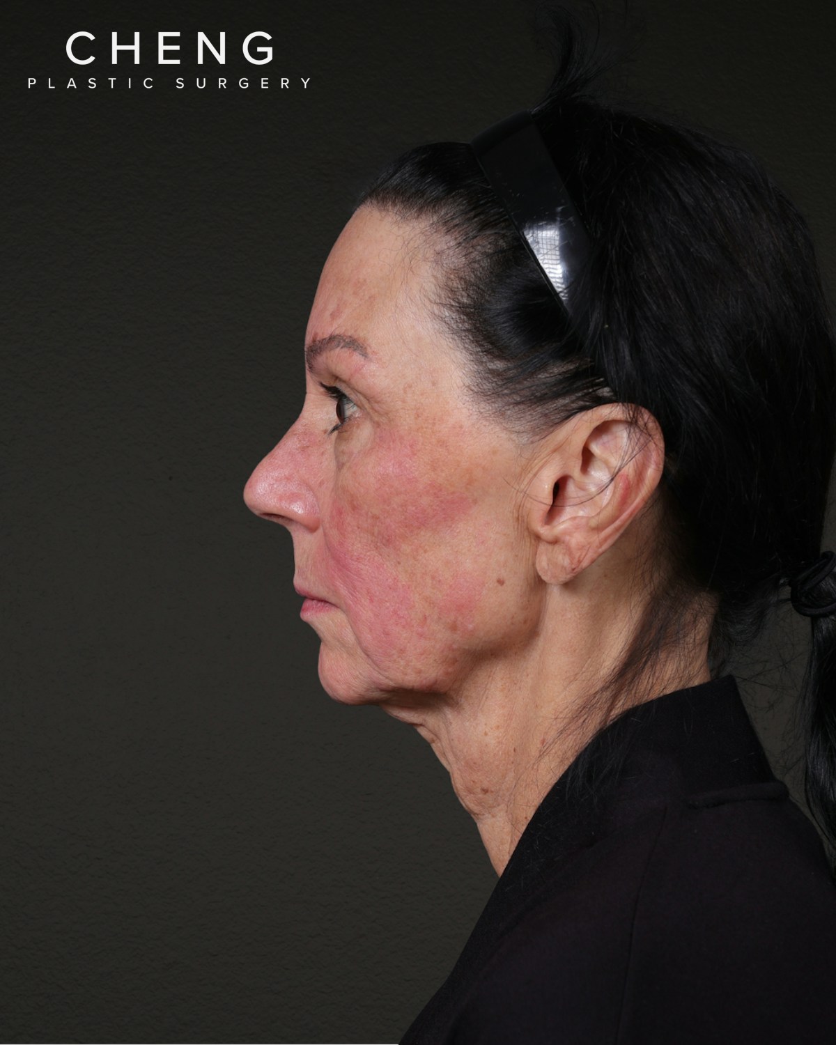 Neck Lift Before & After Gallery - Patient 255571 - Image 3