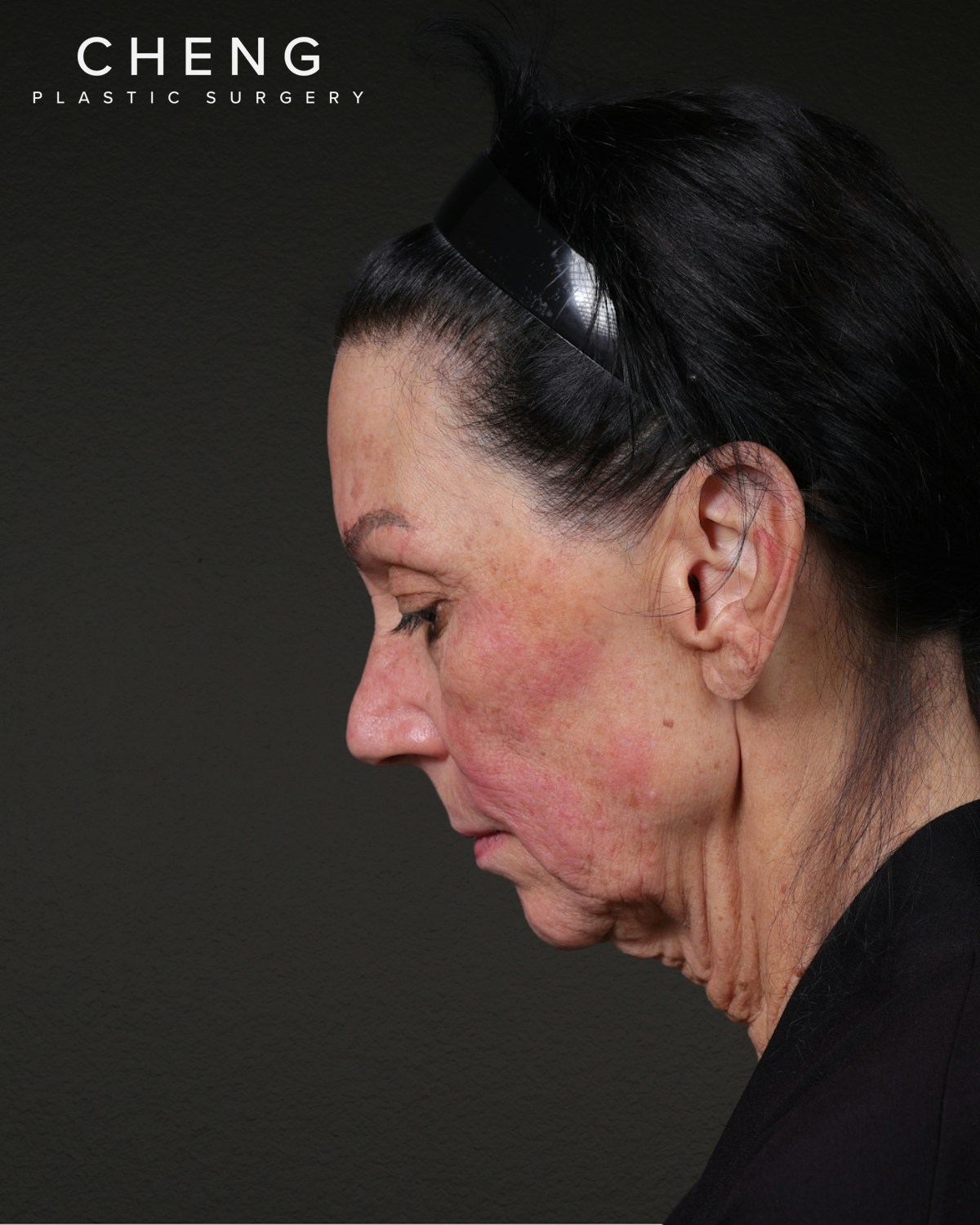 Neck Lift Before & After Gallery - Patient 255571 - Image 1