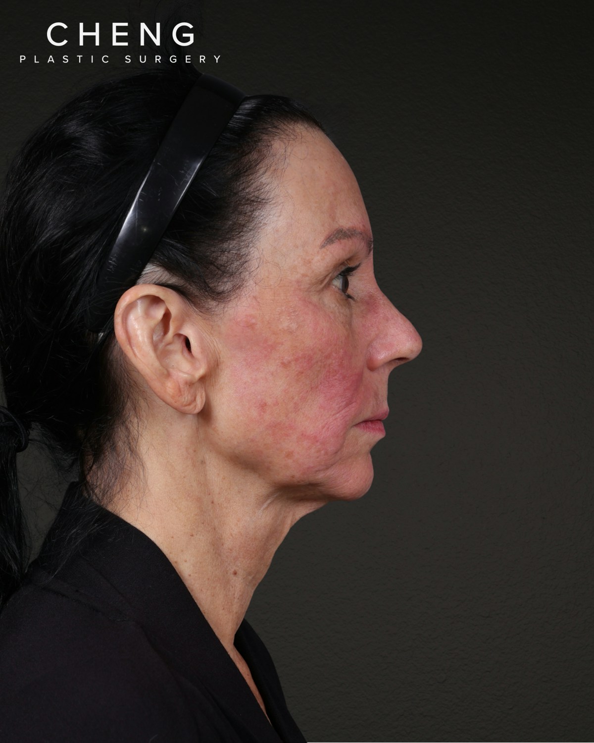Neck Lift Before & After Gallery - Patient 255571 - Image 7