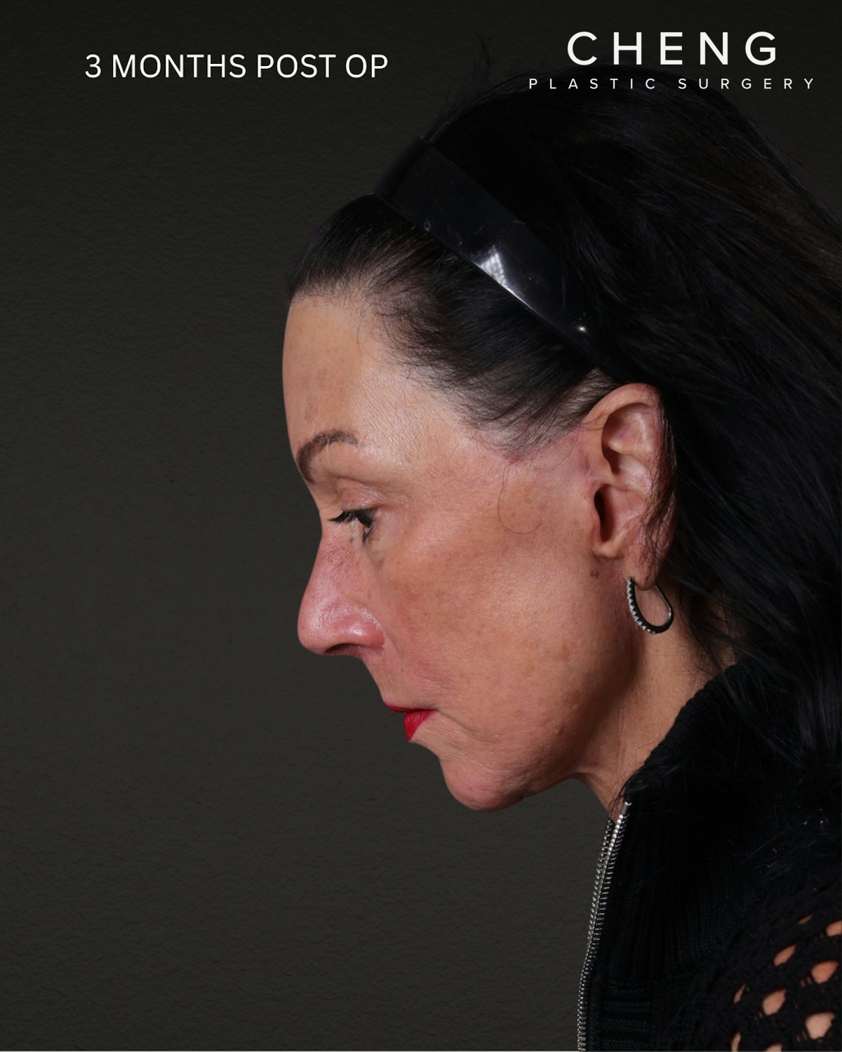 Neck Lift Before & After Gallery - Patient 255571 - Image 2
