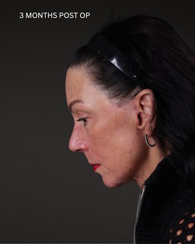 Neck Lift Before & After Gallery - Patient 255571 - Image 2