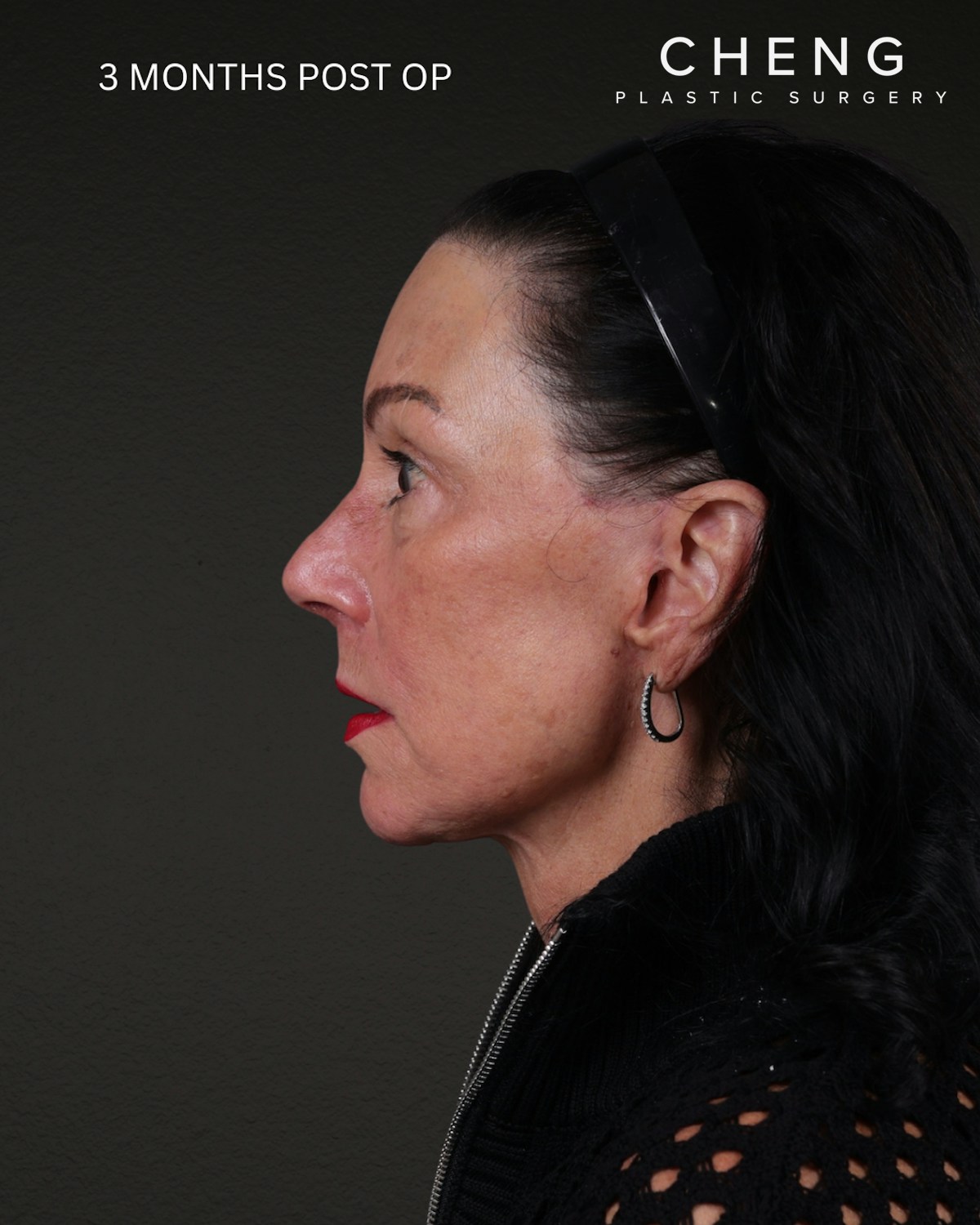 Neck Lift Before & After Gallery - Patient 255571 - Image 4