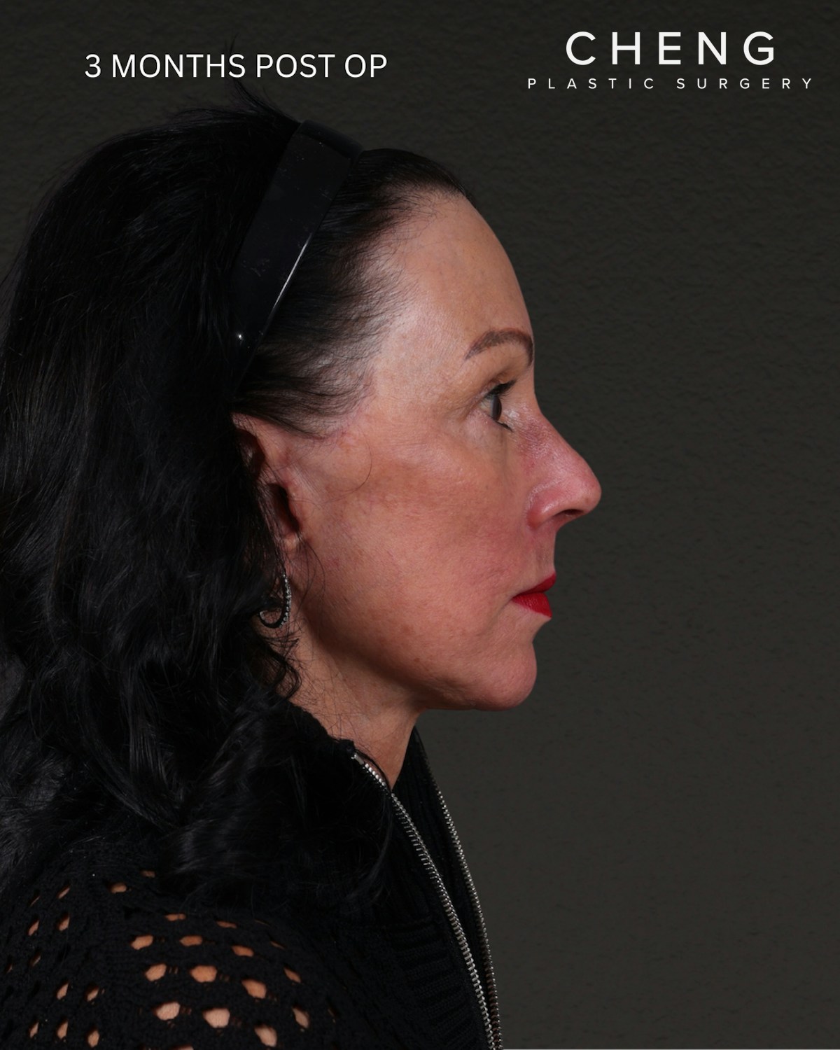 Neck Lift Before & After Gallery - Patient 255571 - Image 8