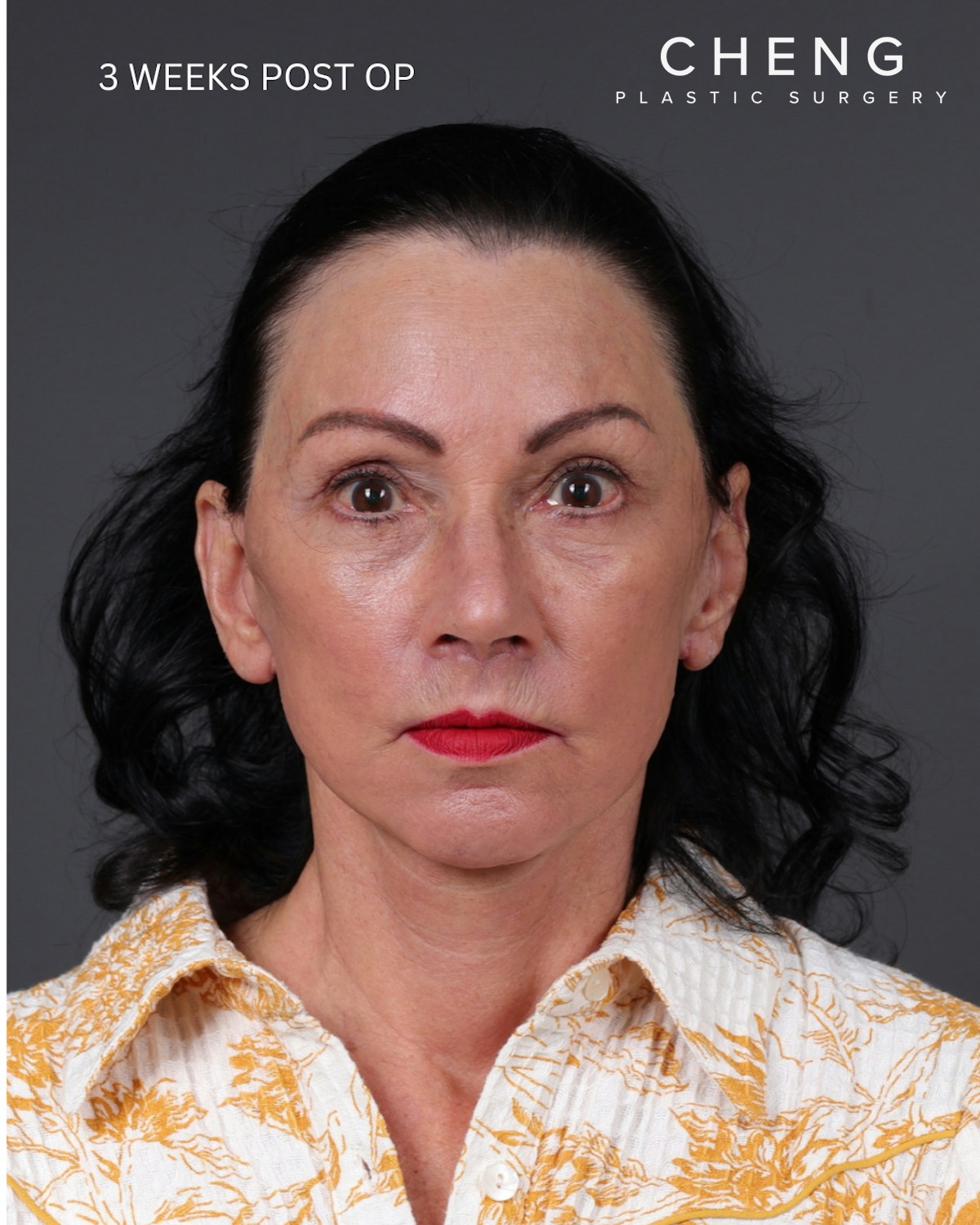 Neck Lift Before & After Gallery - Patient 255571 - Image 10