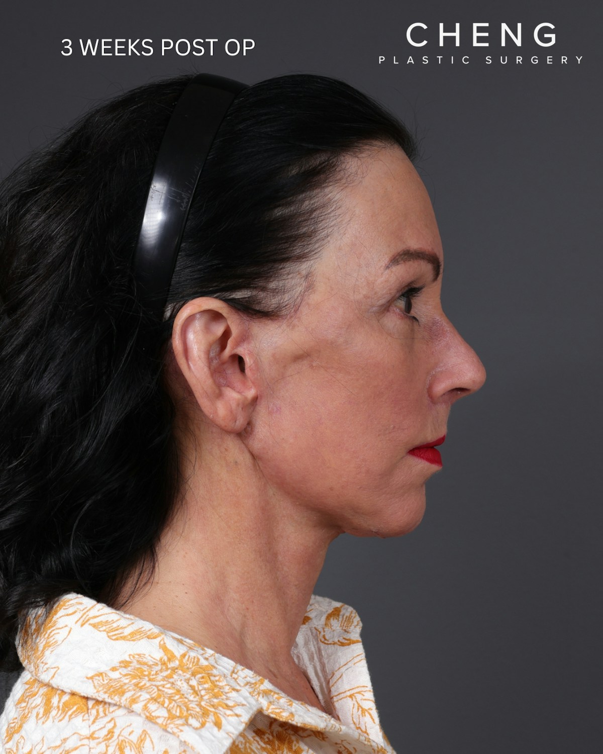 Neck Lift Before & After Gallery - Patient 255571 - Image 14