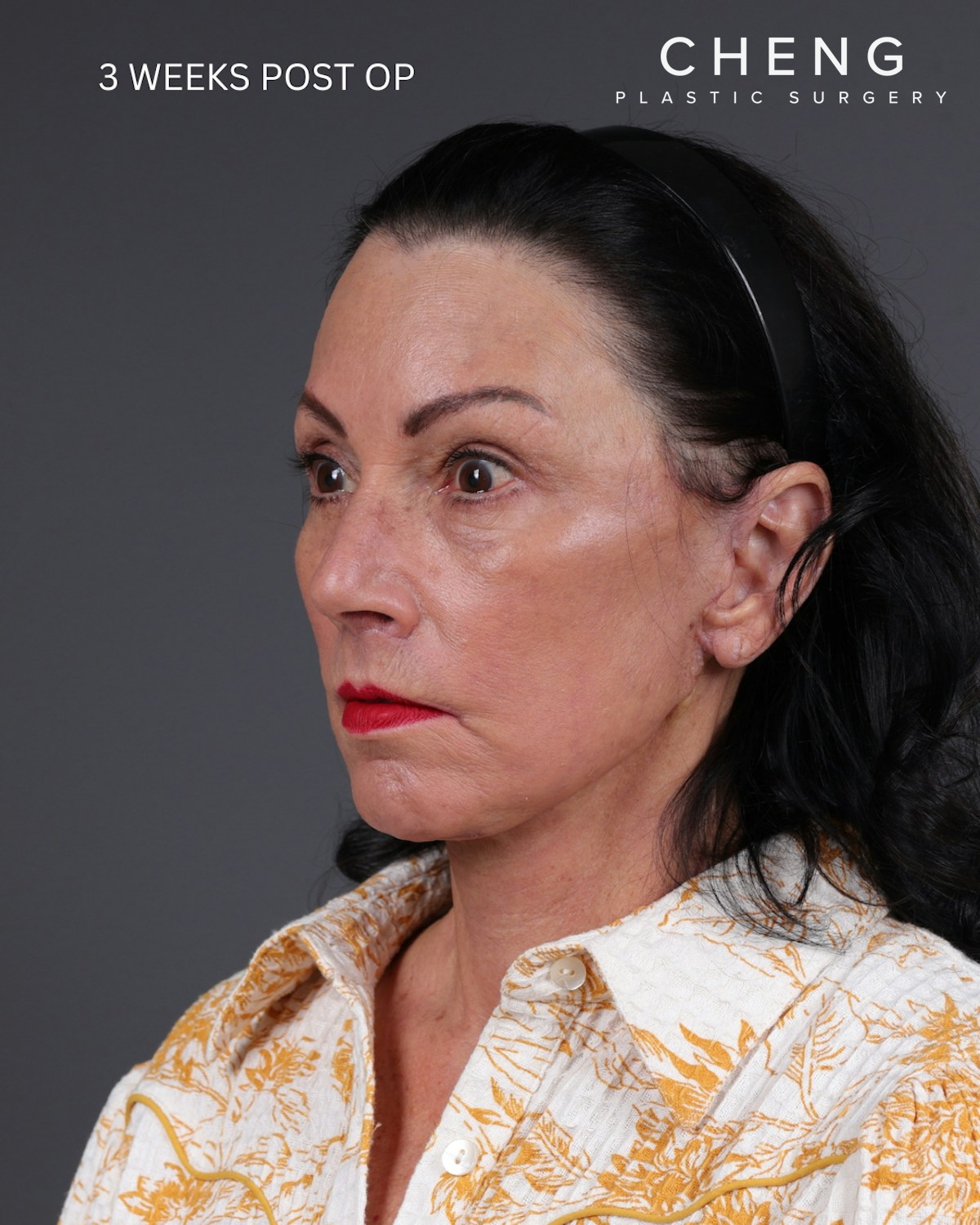 Neck Lift Before & After Gallery - Patient 255571 - Image 16