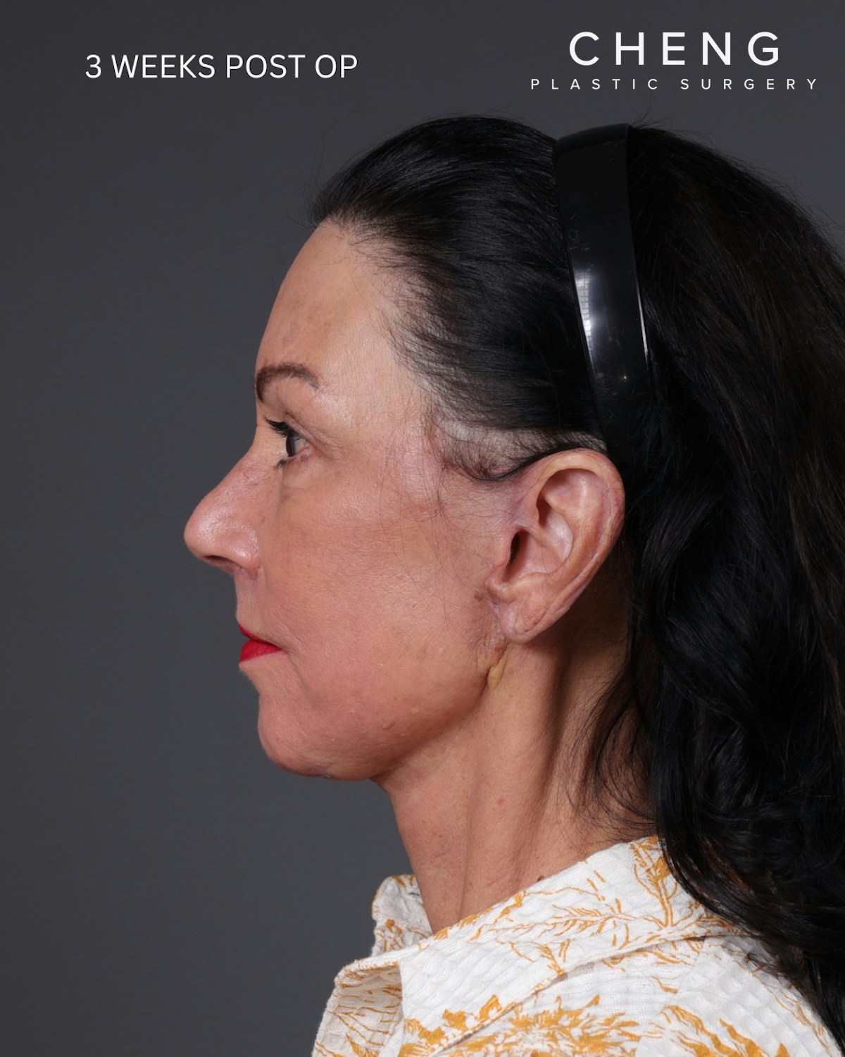 Neck Lift Before & After Gallery - Patient 255571 - Image 18