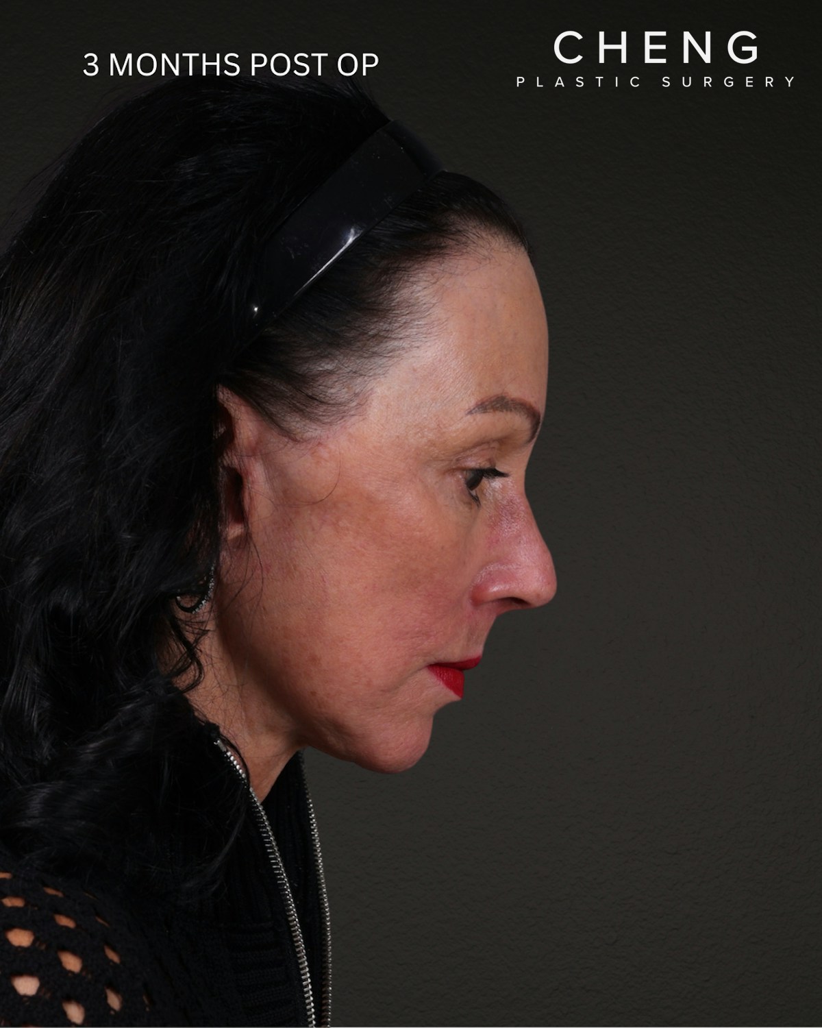 Neck Lift Before & After Gallery - Patient 255571 - Image 6