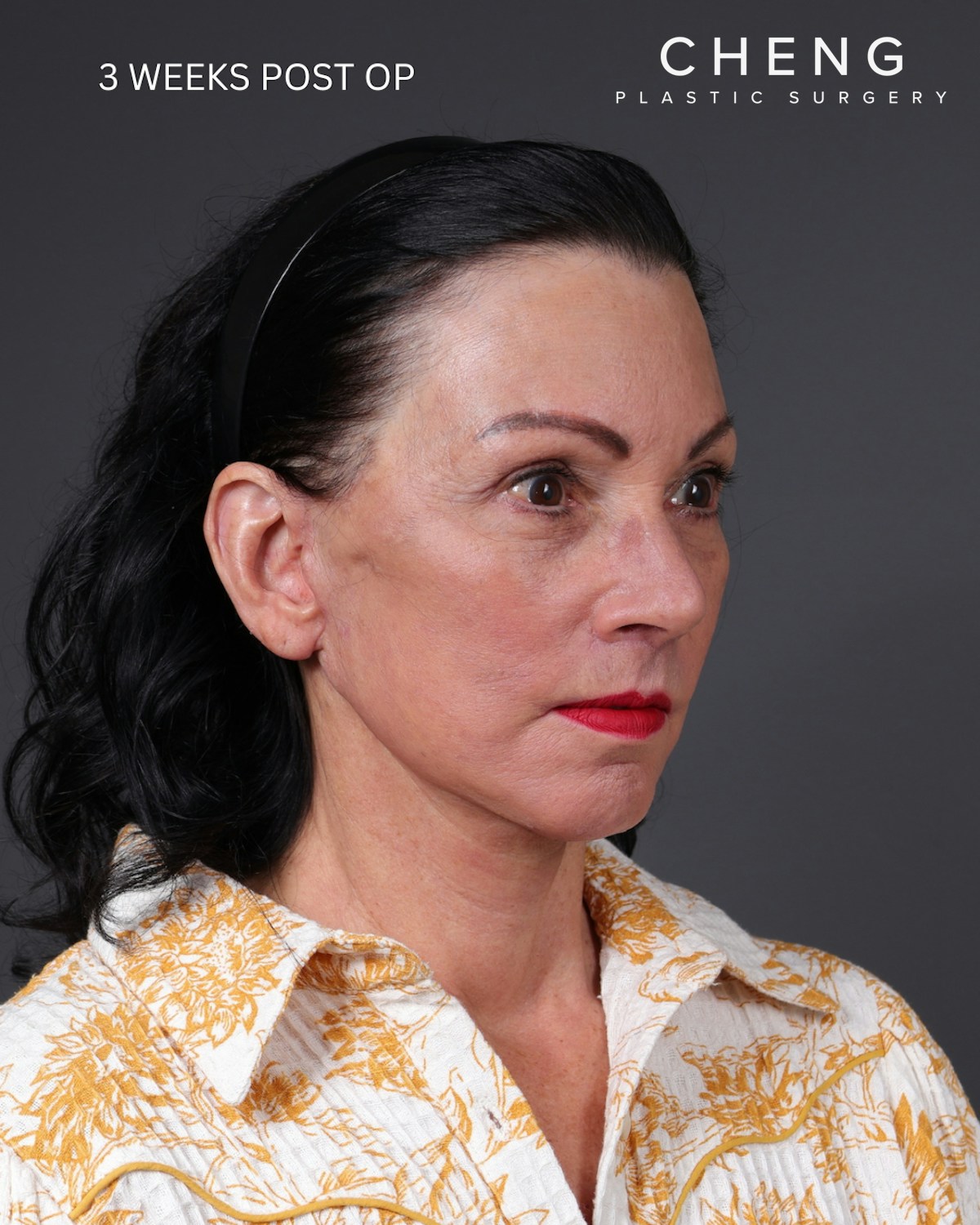 Neck Lift Before & After Gallery - Patient 255571 - Image 12