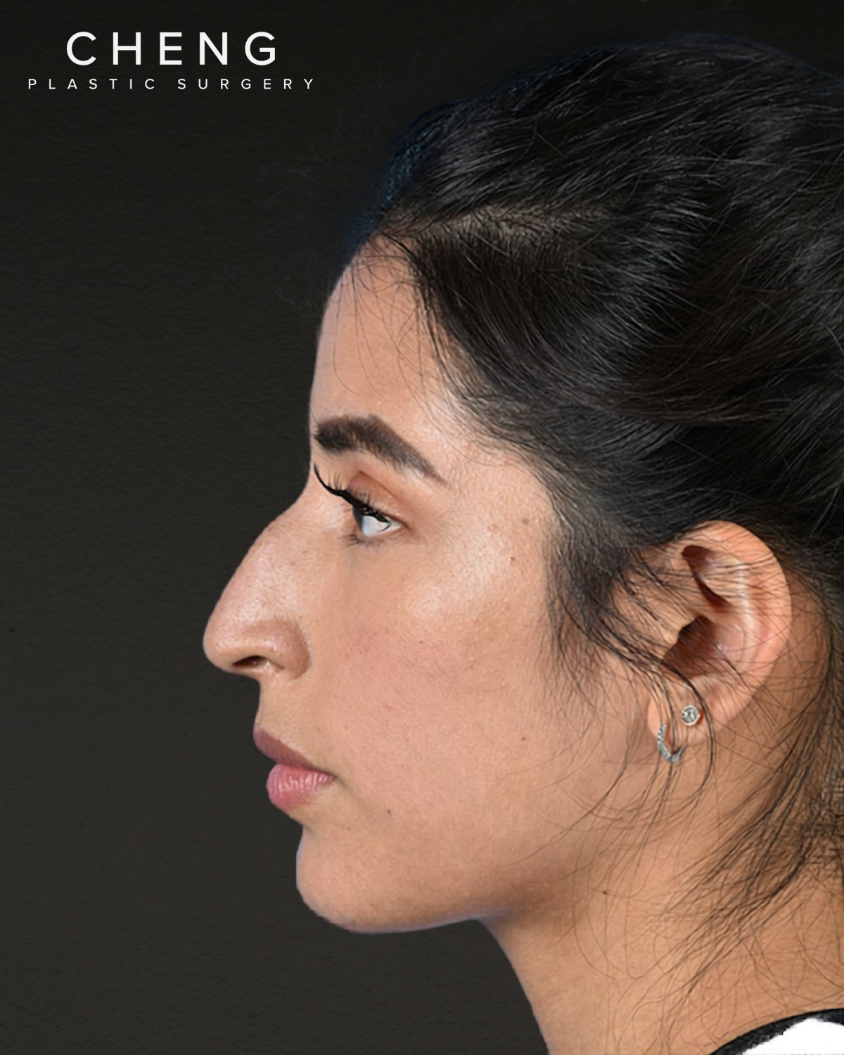 Rhinoplasty Before & After Gallery - Patient 428815 - Image 9