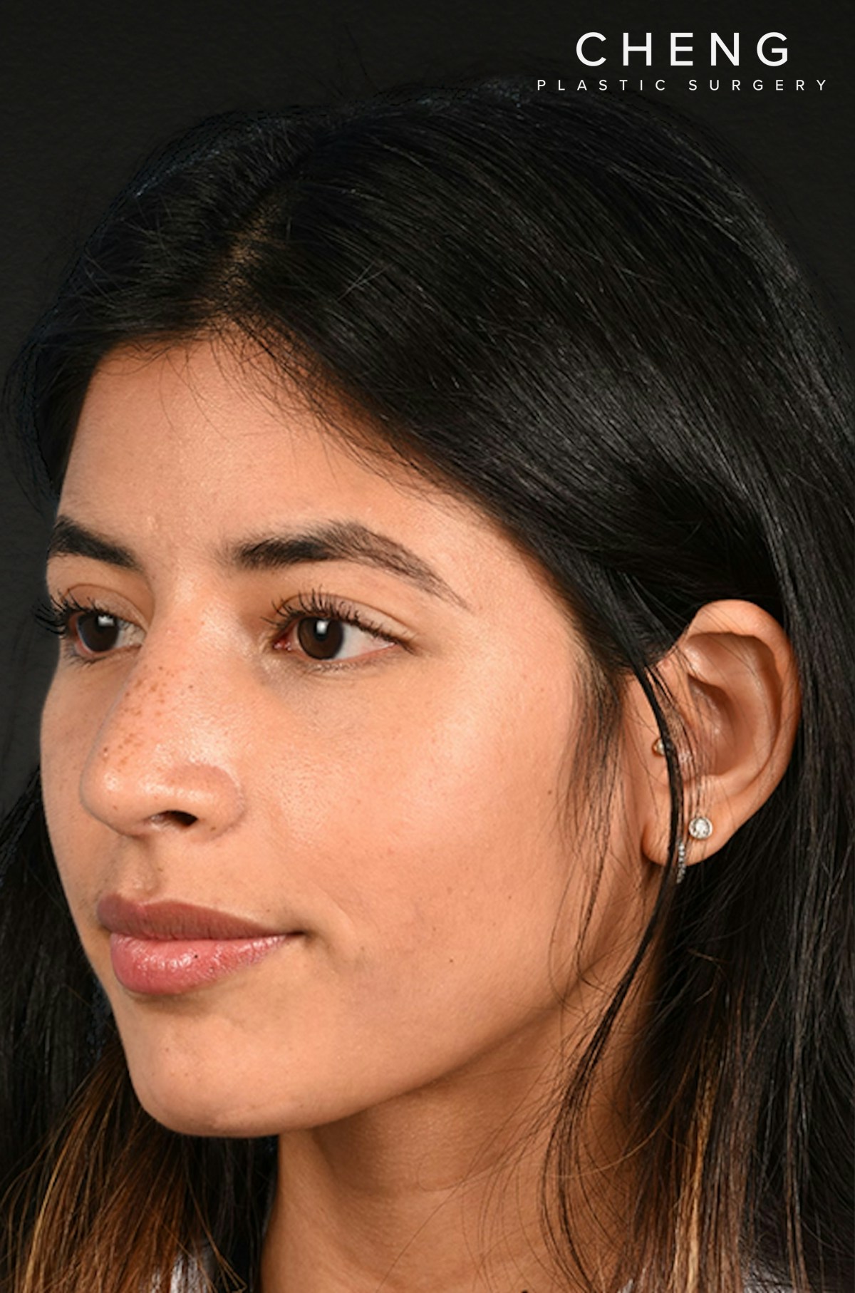 Rhinoplasty Before & After Gallery - Patient 428815 - Image 8