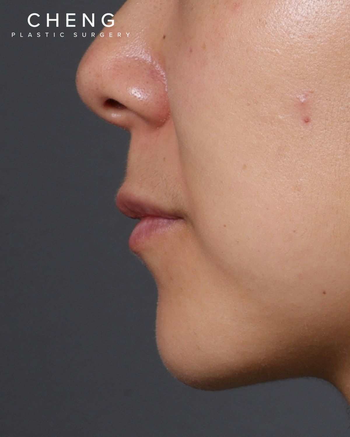 Dermal Fillers Before & After Gallery - Patient 206577 - Image 5